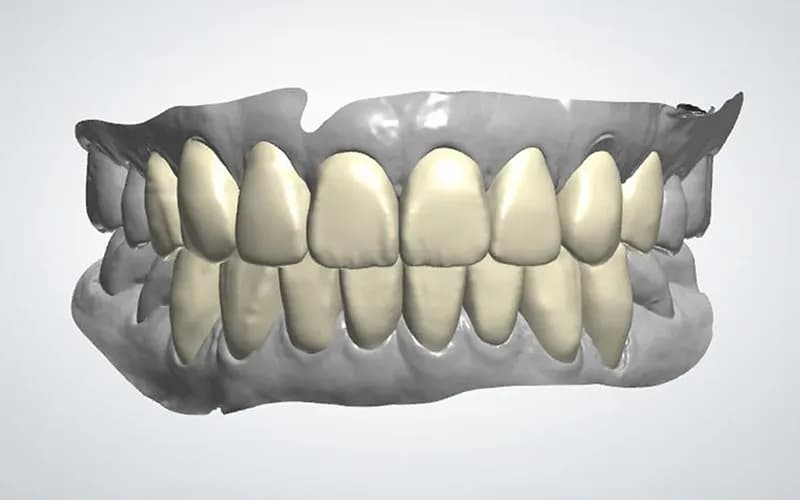 首尔院内技工室用于设计当天瓷贴面的3D扫描