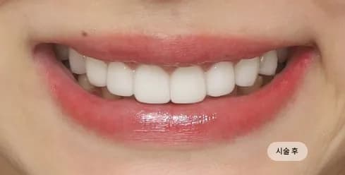 治疗后