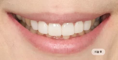 治疗后