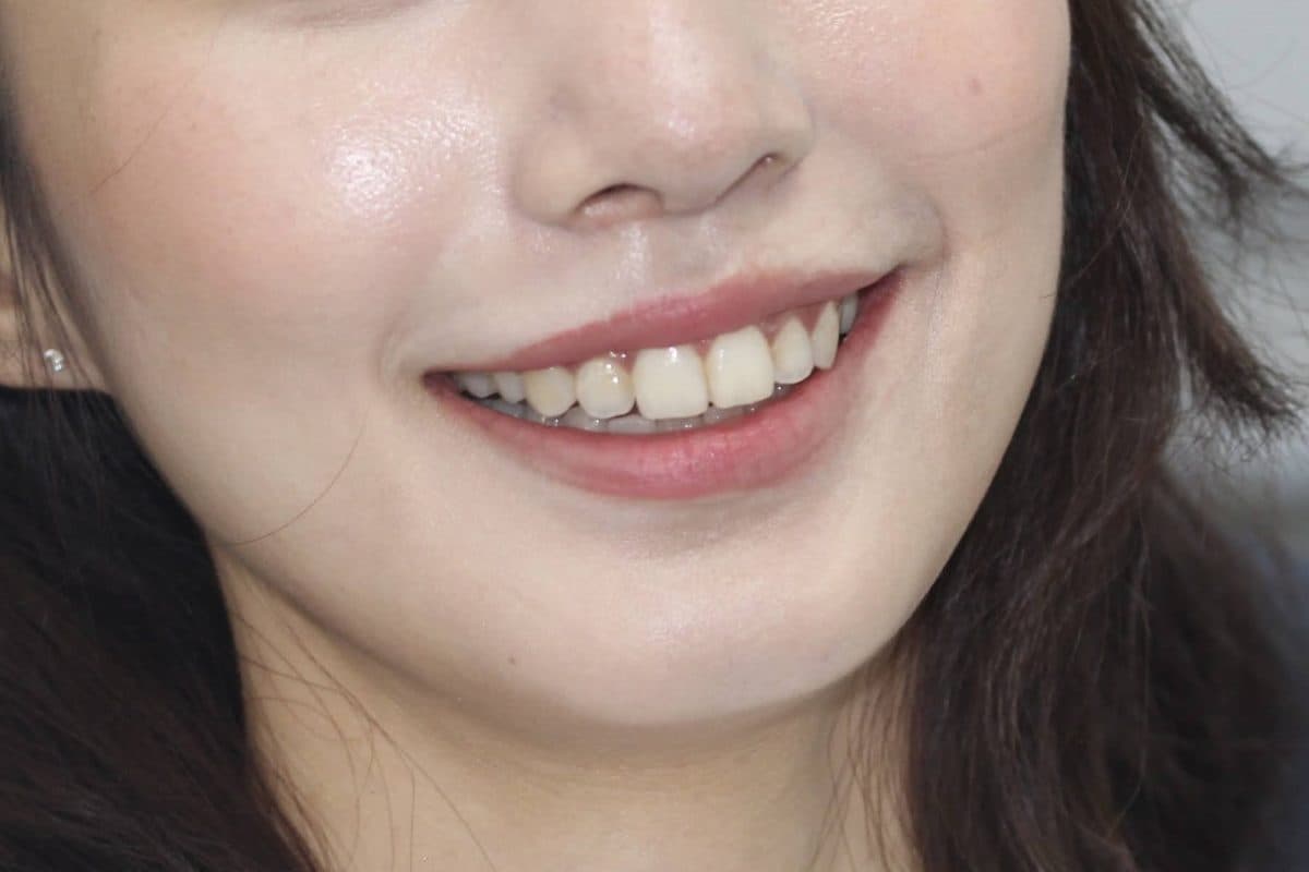 블랑쉬 거미스마일 보톡스 실제 사례 시술 후, 웃을 때 보이는 윗잇몸이 줄어든 모습