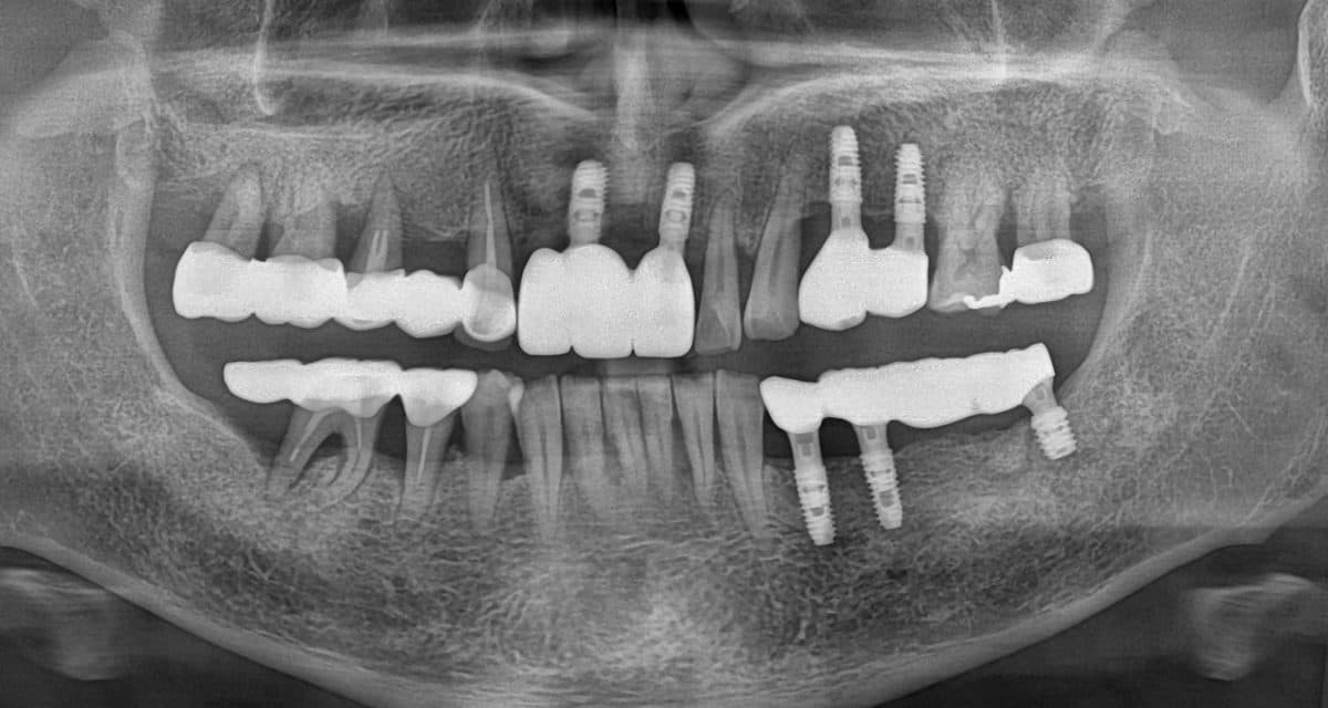 블랑쉬치과 임플란트 실제 사례 1 크라운 장착 후 파노라마 X-ray, 크라운과 크라운·지대주 연결 부위 표시