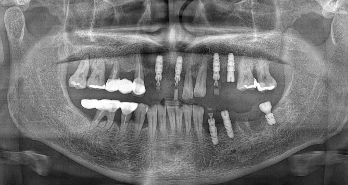 블랑쉬치과 임플란트 실제 사례 1 식립 직후 파노라마 X-ray, 아래턱 잇몸뼈 안에 심은 인공 치근 위치 표시