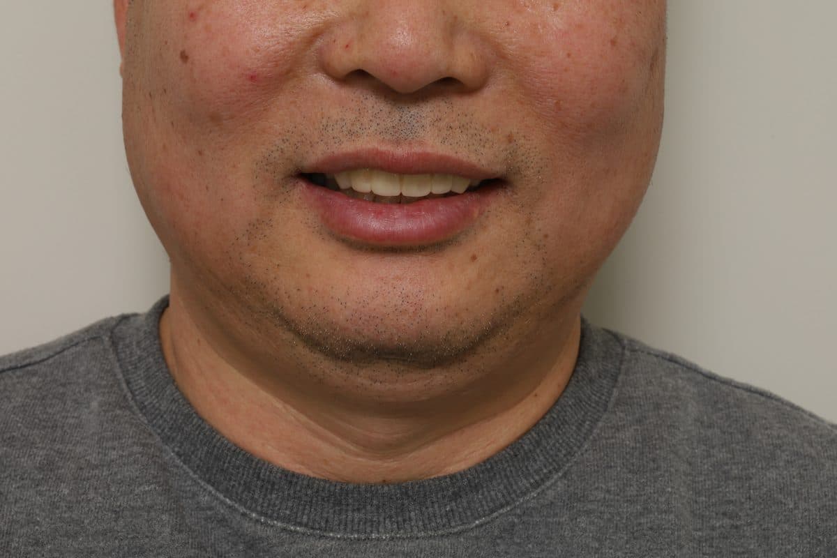 블랑쉬 임플란트 실제 사례 4 치료 후 미소