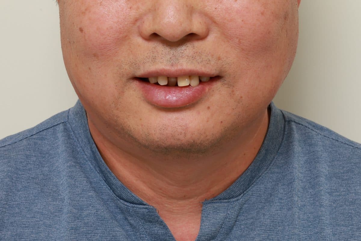 블랑쉬 임플란트 실제 사례 4 치료 전 미소