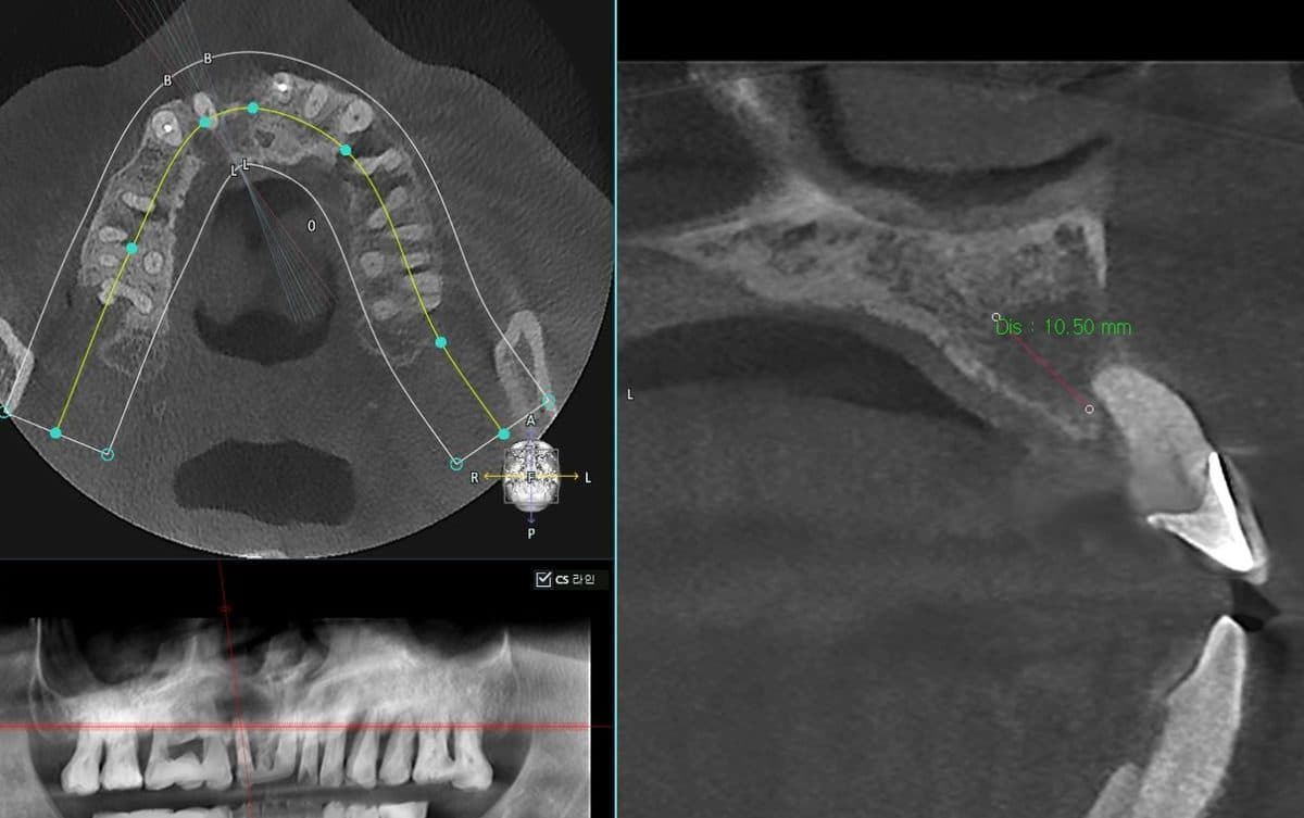 블랑쉬치과 임플란트 상담 전 3D CT 촬영 장면
