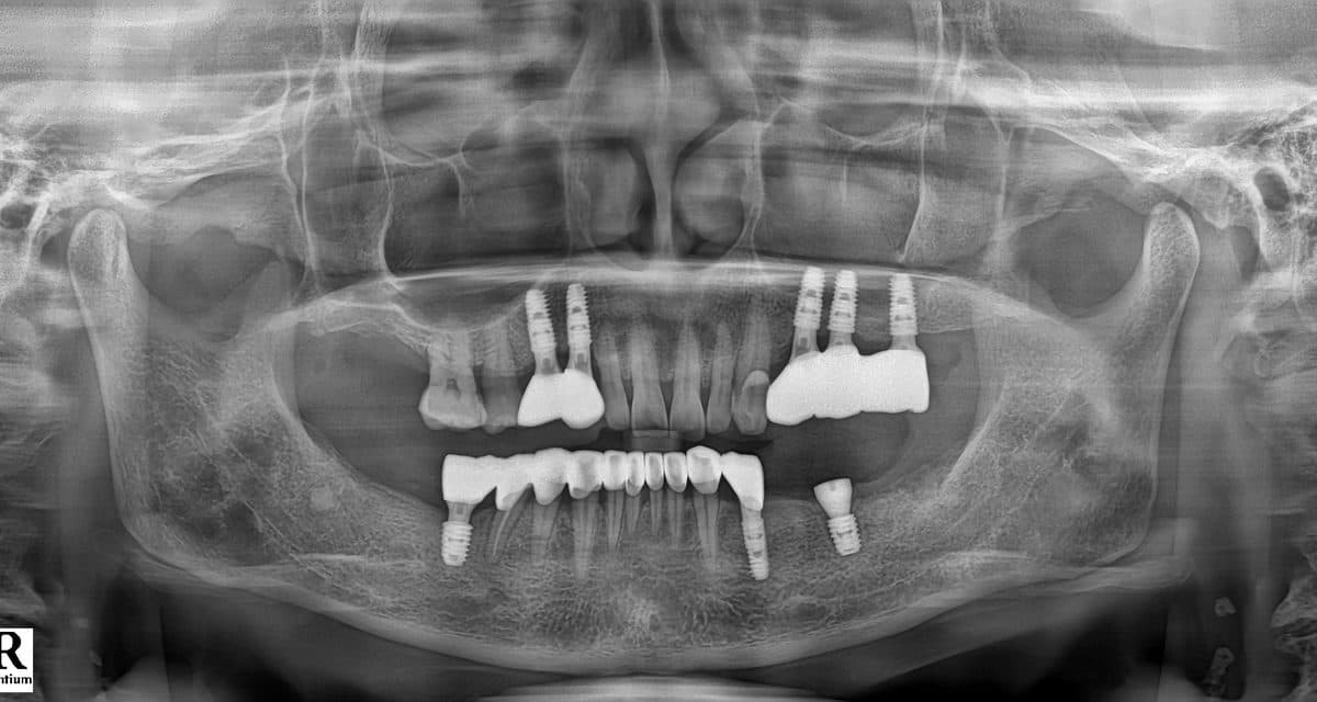 블랑쉬 임플란트 재수술 실제 사례 1 재수술 후 파노라마 X-ray