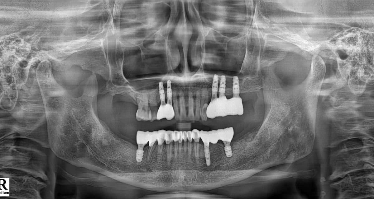 블랑쉬 임플란트 재수술 실제 사례 1 재수술 전 파노라마 X-ray