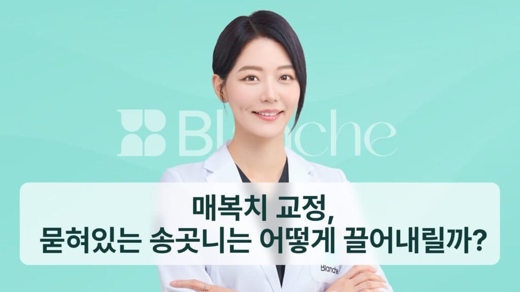 썸네일 - 매복치 교정