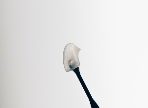 블랑쉬 치과의 라미네이트 표면 마감을 보여주는 치아 보철 샘플 클로즈업