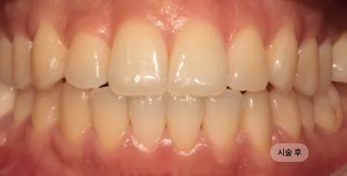 20대 여성 치아 교합 교정 치료 후 사진, 치열과 교합 개선 결과
