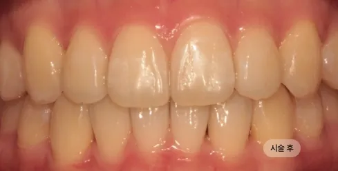 20대 여성 인비절라인 교정 치료 후 사진, 투명교정으로 치열 개선