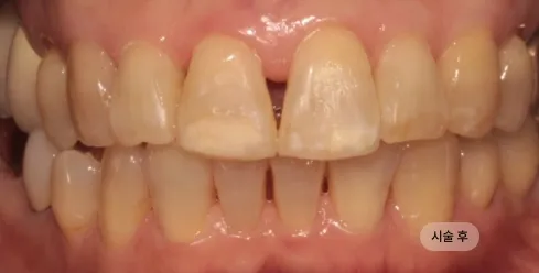 30대 여성 앞니 교정 치료 후, 앞니 배열이 고르게 정돈된 모습