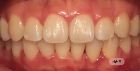 30대 남성 앞니 교정 치료 후, 앞니 교합과 배열이 안정된 상태