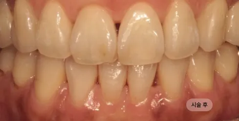 40대 여성 인비절라인 교정 치료 후 고르게 정돈된 치열과 교합
