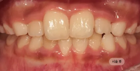 10대 여성 인비절라인 교정 치료 후 안정된 치열과 교합 모습