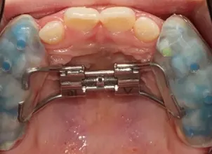 악궁확장장치와 페이스마스크, 좁은 위턱을 확장하고 전방 성장을 유도하는 교정