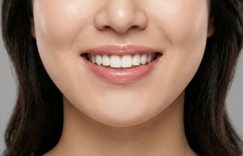 블랑쉬치과 거미스마일 보톡스 시술을 통해 웃을 때 잇몸 노출을 완화한 입 주변 이미지