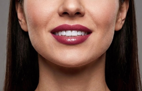 블랑쉬치과 입술 필러 시술로 입술 볼륨과 라인을 표현한 이미지