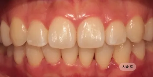 20대 남성 앞니 교정 치료 후 사진, 앞니 배열 개선 결과