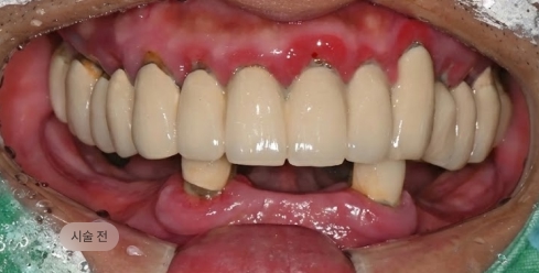 디지털 풀아치 임플란트 시술 전 구강 상태, 잇몸 염증과 치아 상실이 동반된 블랑쉬치과 치료 전 사례