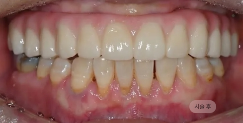 디지털 풀아치 임플란트 시술 후 모습, 저작 기능과 심미를 회복한 블랑쉬치과 치료 결과 사례