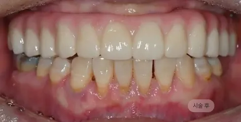 디지털 풀아치 임플란트 시술 후 하악 전악 복원 모습, 안정적인 교합을 완성한 블랑쉬치과 사례