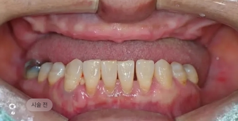 디지털 풀아치 임플란트 시술 전 하악 치아 상태, 잔존 치아와 잇몸 문제를 확인하는 블랑쉬치과 사례