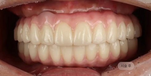 디지털 풀아치 임플란트 시술 후 하악 전악 복원 모습, 안정적인 교합을 완성한 블랑쉬치과 사례