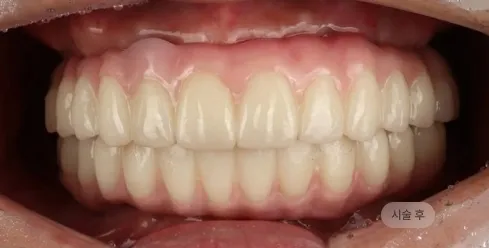 디지털 풀아치 임플란트 시술 후 모습, 저작 기능과 심미를 회복한 블랑쉬치과 치료 결과 사례