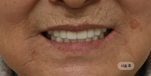 70대 여성 풀아치 임플란트 전악 시술 후 결과