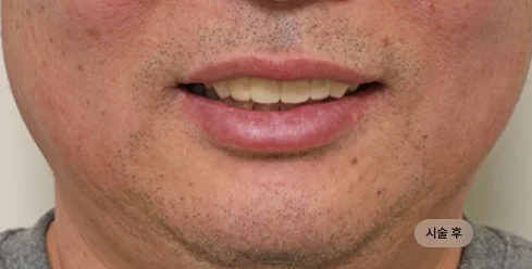 50대 남성 전체임플란트 상악 시술 후 결과