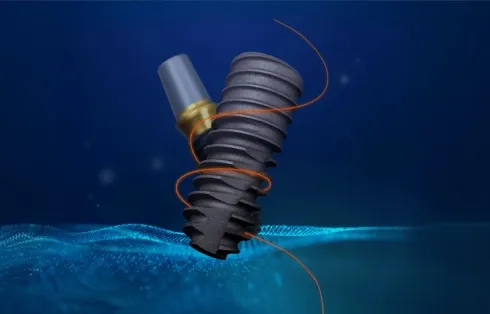 오스템 임플란트 이미지, 국내 치과에서 널리 사용되는 표준 임플란트 시스템