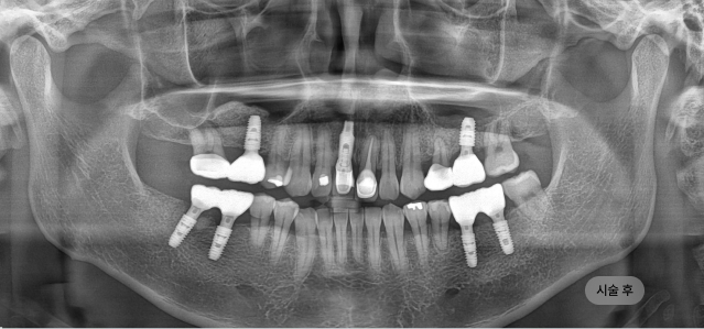 네비게이션 임플란트 시술 후 파노라마 엑스레이, 계획에 따라 임플란트가 정확히 식립된 상태