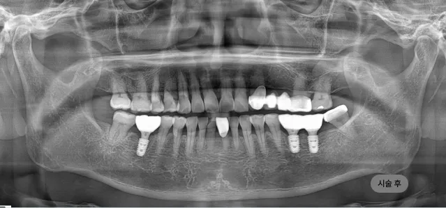네비게이션 임플란트 시술 후 파노라마 엑스레이, 오차를 최소화해 임플란트가 자리한 결과