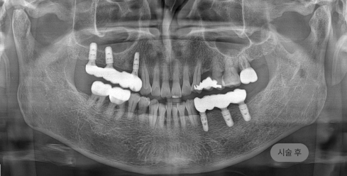 무절개 임플란트 시술 후 파노라마 엑스레이, 최소 침습으로 임플란트 식립이 완료된 치료 결과