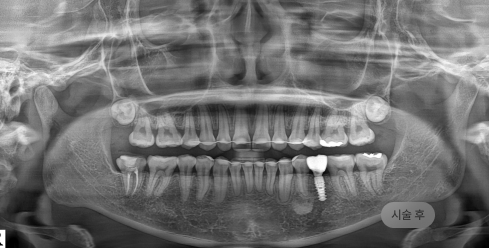 무절개 임플란트 시술 후 파노라마 엑스레이, 절개 없이 임플란트가 안정적으로 자리한 모습