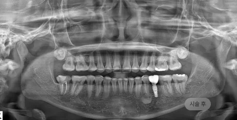 무절개 임플란트 시술 후 파노라마 엑스레이, 절개 없이 임플란트가 안정적으로 자리한 모습
