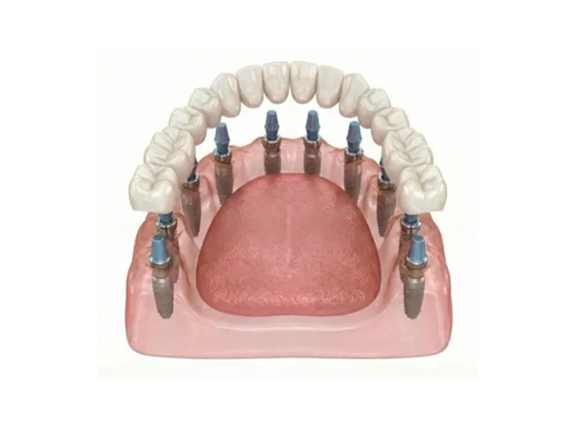 全顎インプラント