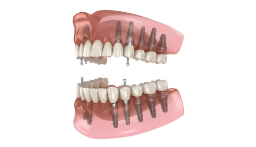디지털 풀아치임플란트