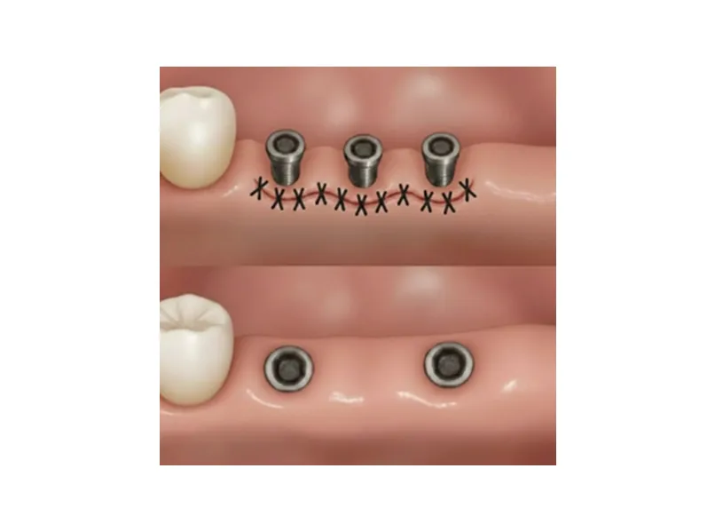 フラップレスインプラント