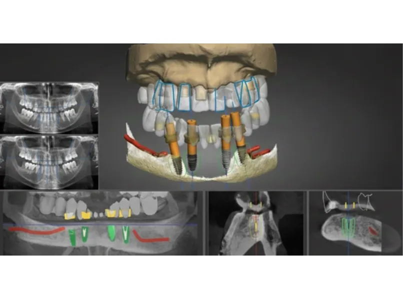 ナビゲーションインプラント