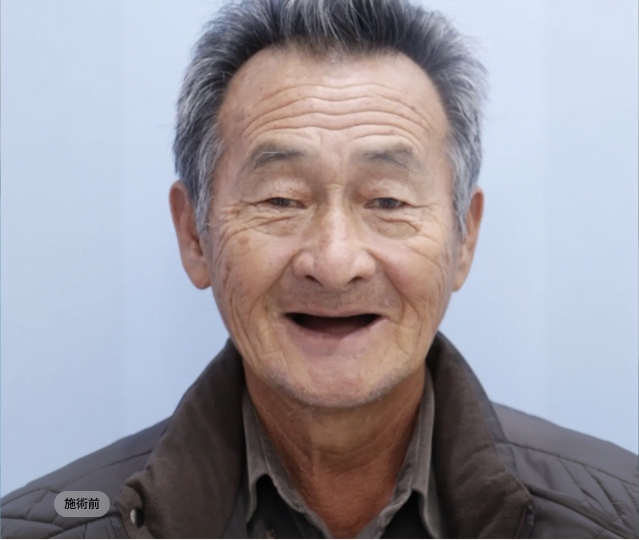 전체임플란트 시술 전 얼굴 정면 모습, 치아 상실로 미소와 입술 지지가 부족한 블랑쉬치과 치료 전 사례