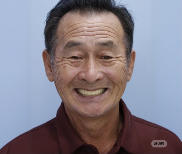 전체임플란트 시술 후 얼굴 정면 모습, 자연스러운 미소와 저작 기능을 회복한 블랑쉬치과 치료 결과