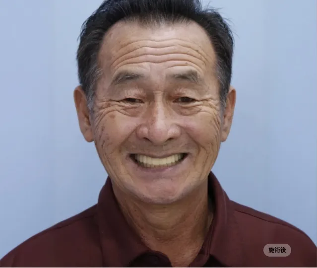 전체임플란트 시술 후 얼굴 정면 모습, 자연스러운 미소와 저작 기능을 회복한 블랑쉬치과 치료 결과