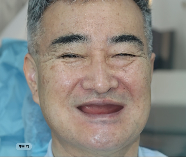 전체임플란트 시술 전 고령 환자 얼굴 모습, 다수 치아 소실로 표정과 발음이 불편했던 치료 전 사례