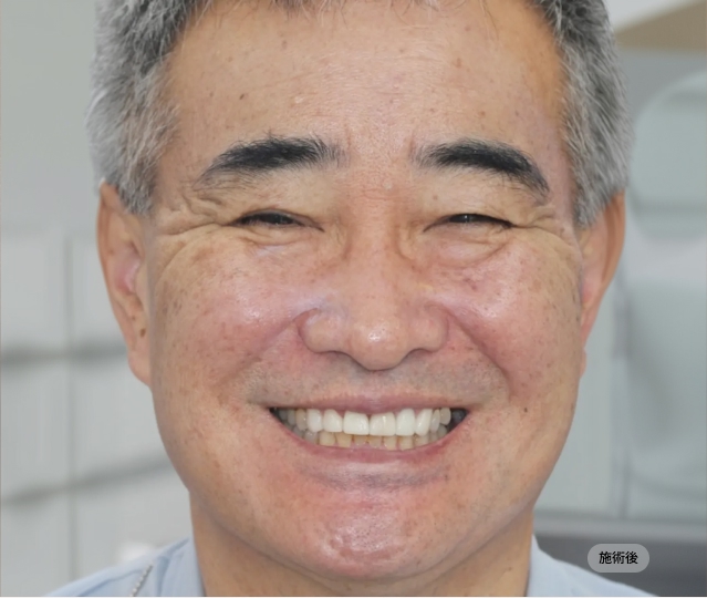 전체임플란트 시술 후 얼굴 정면 모습, 자연스러운 미소와 저작 기능을 회복한 블랑쉬치과 치료 결과