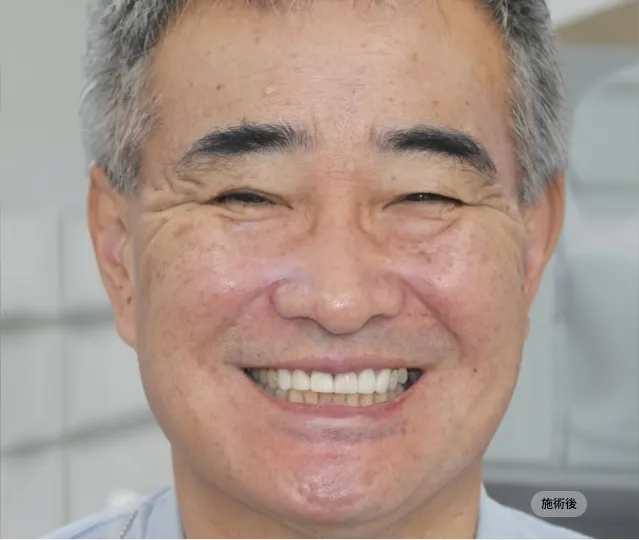 전체임플란트 시술 후 얼굴 정면 모습, 자연스러운 미소와 저작 기능을 회복한 블랑쉬치과 치료 결과