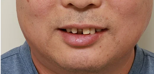 50대 남성 전체임플란트 상악 시술 전 구강 상태