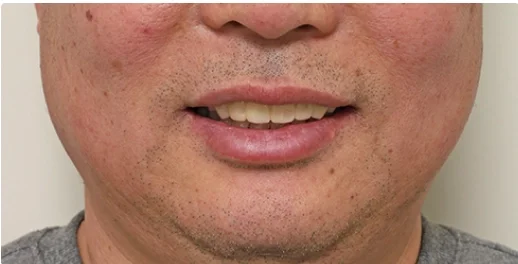 50대 남성 전체임플란트 상악 시술 후 결과