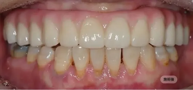 디지털 풀아치 임플란트 시술 후 모습, 저작 기능과 심미를 회복한 블랑쉬치과 치료 결과 사례